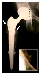 Osteomilelit